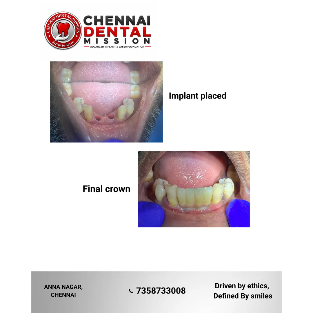 Can I get a dental implant if I have diabetes?