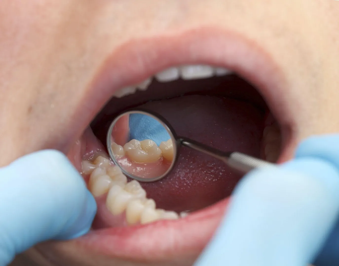 Why do my teeth look longer than before?