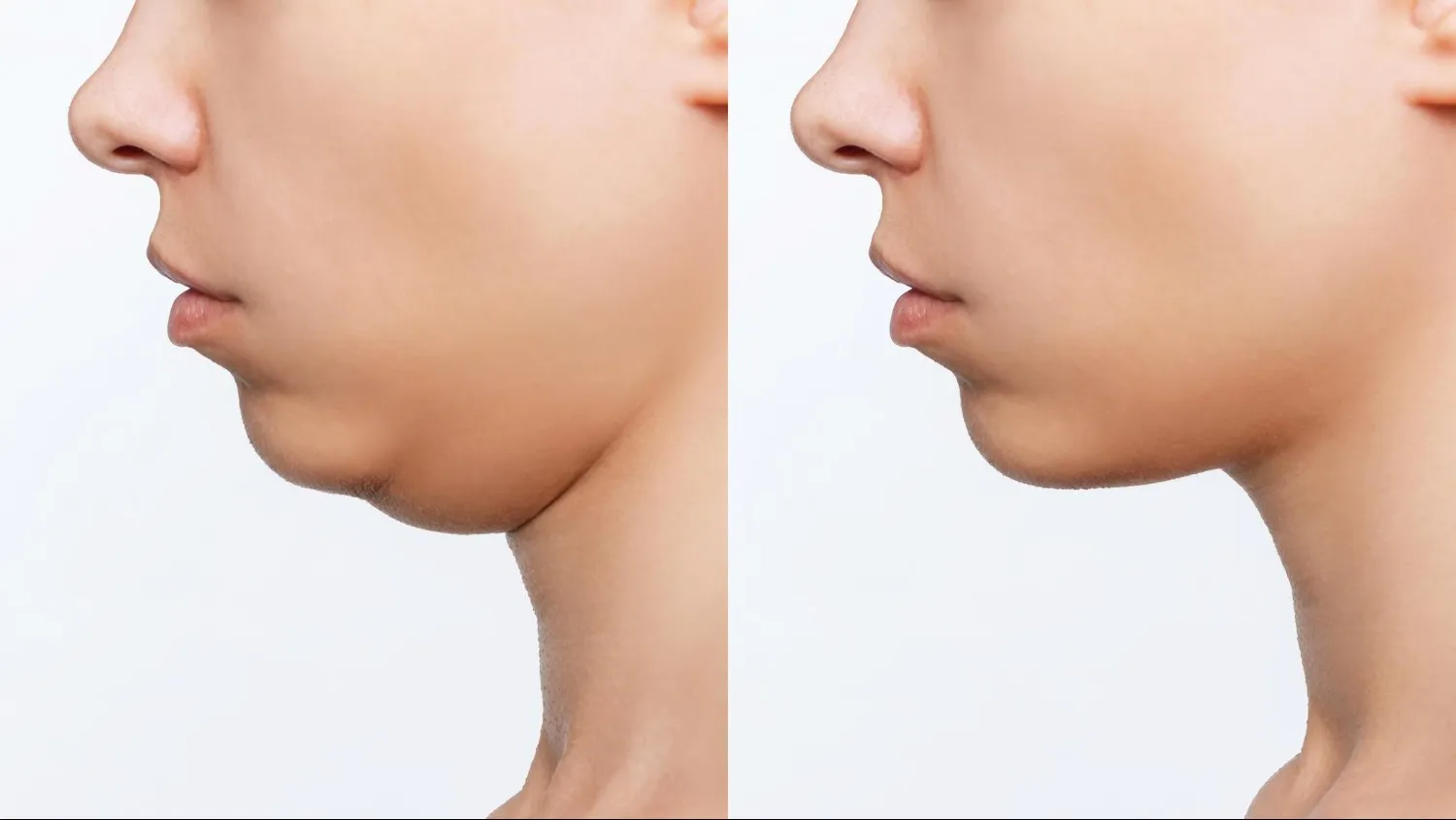 How the Double Chin Reduction Specialist Can Help You Decide If Non-Surgical Treatment Is Right
