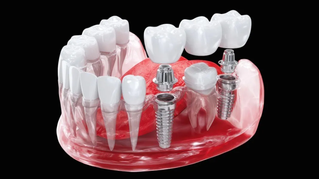 Dental Implants in Vikas Puri – A Long-Term Option for Missing Teeth