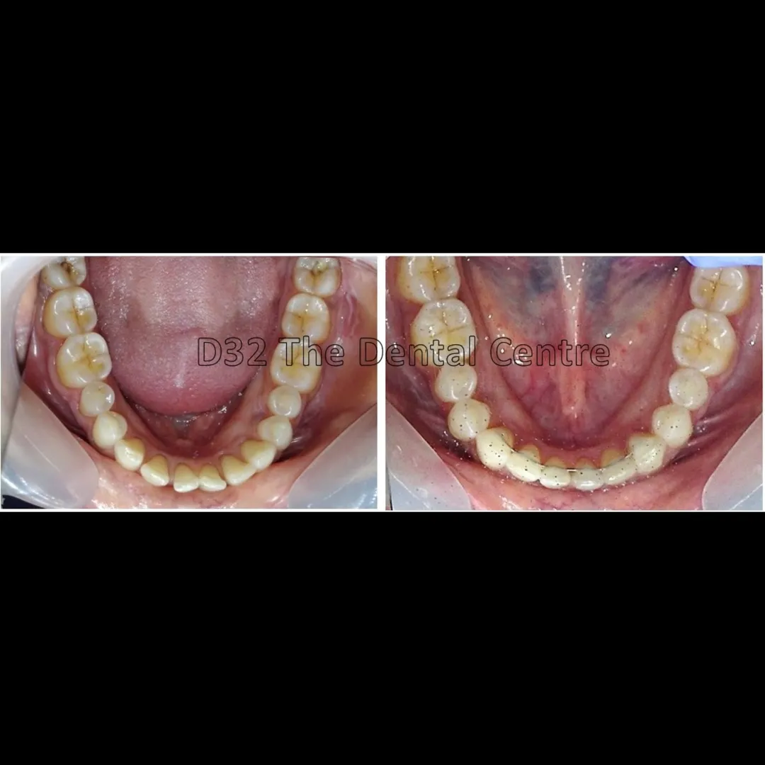 ✨ Straighten Your Smile with Comfort, Precision & Confidence at D32 The Dental Centre ✨