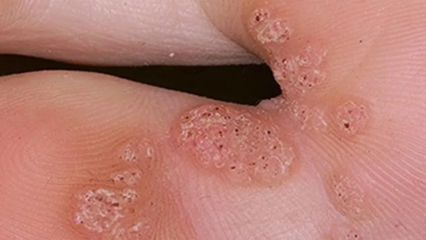 Treatment of Plantar Warts at Rakesh Reddy's skin Clinic in Sanjar Nagar , Hebbal , Bengaluru