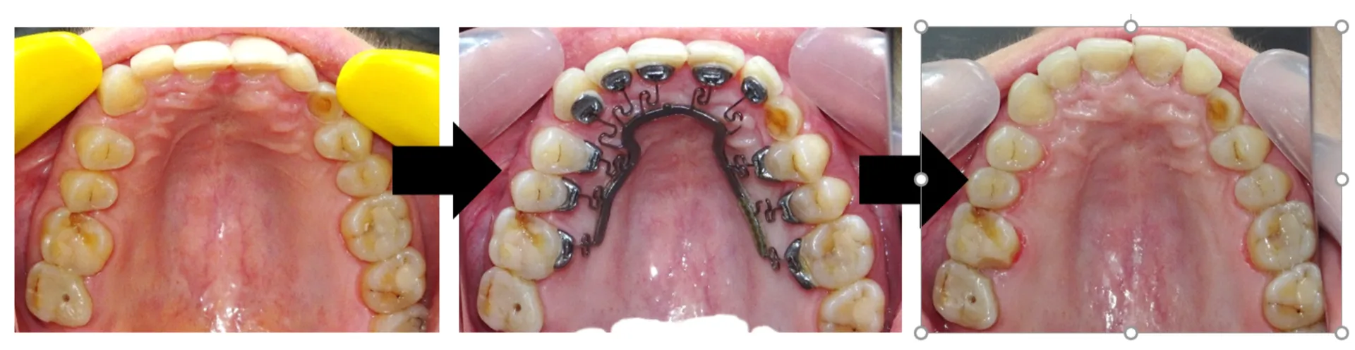 Advanced Orthodontics with the BRAVA® Appliance at D32 The Dental Centre
