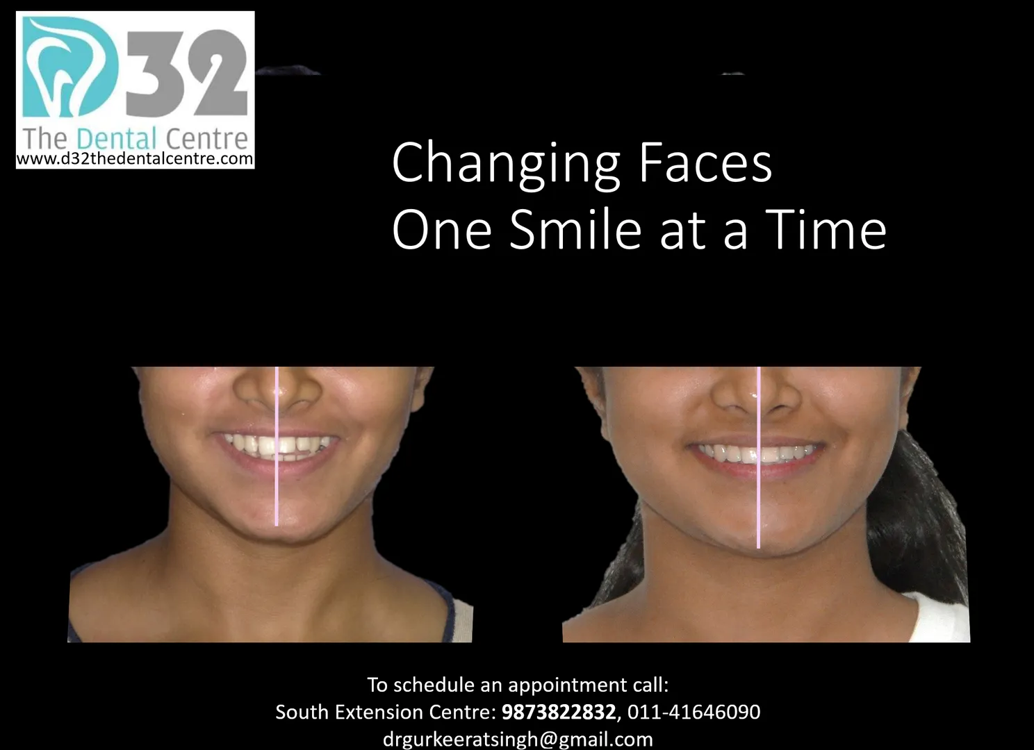 Not every case of facial asymmetry or mandibular deviation requires surgery.