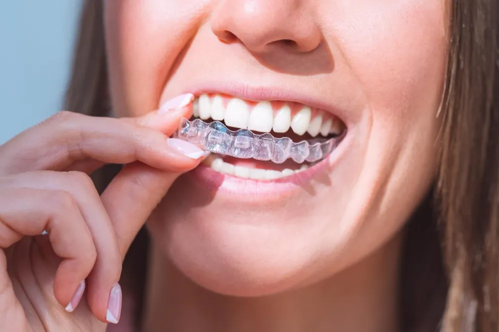 Invisalign in Vikas Puri – A Comfortable Way to Straighten Your Smile