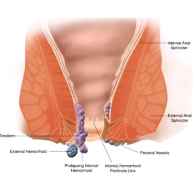 Piles Treatment in Thane – Why Early Attention Can Make a Difference