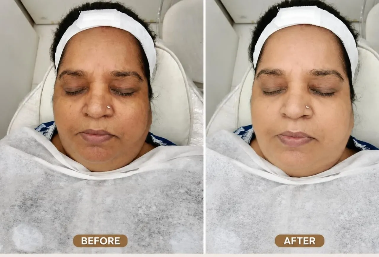 Best Hydrafacial Treatment in Vashi