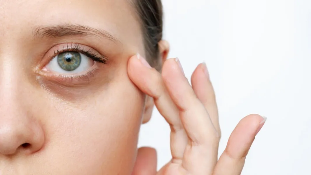 Dark Circles and Tan Removal Treatment in Nagpur for Brighter Skin