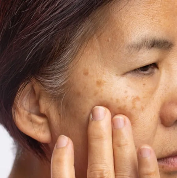 Best Skin Pigmentation Treatment in Delhi