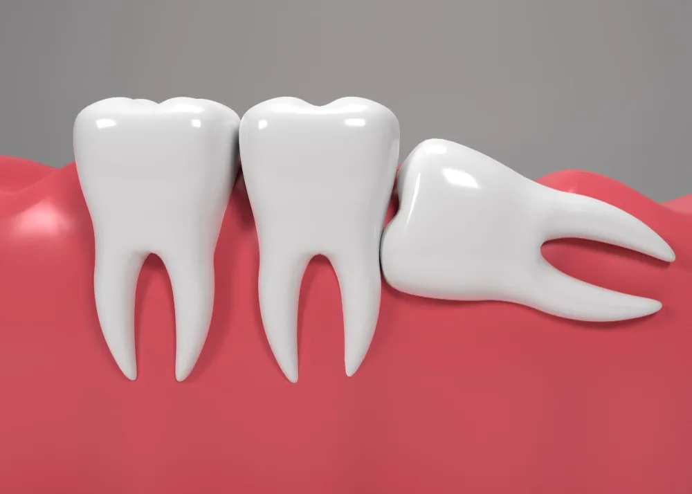 Wisdom Tooth Removal in Fatima Nagar: When Is Extraction Really Necessary?