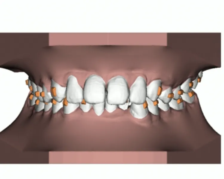 Will Clear Aligners make my teeth loose?