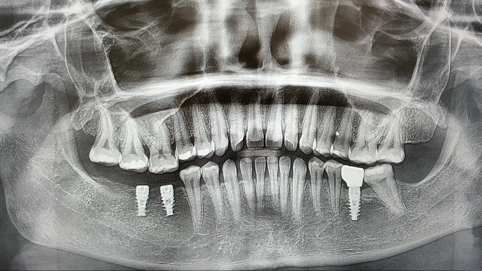 Is it too late to replace a tooth I lost years ago?