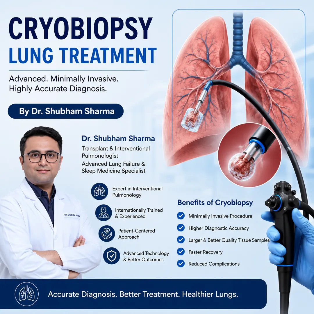 Cryobiopsy Lung Treatment by Dr. Shubham Sharma