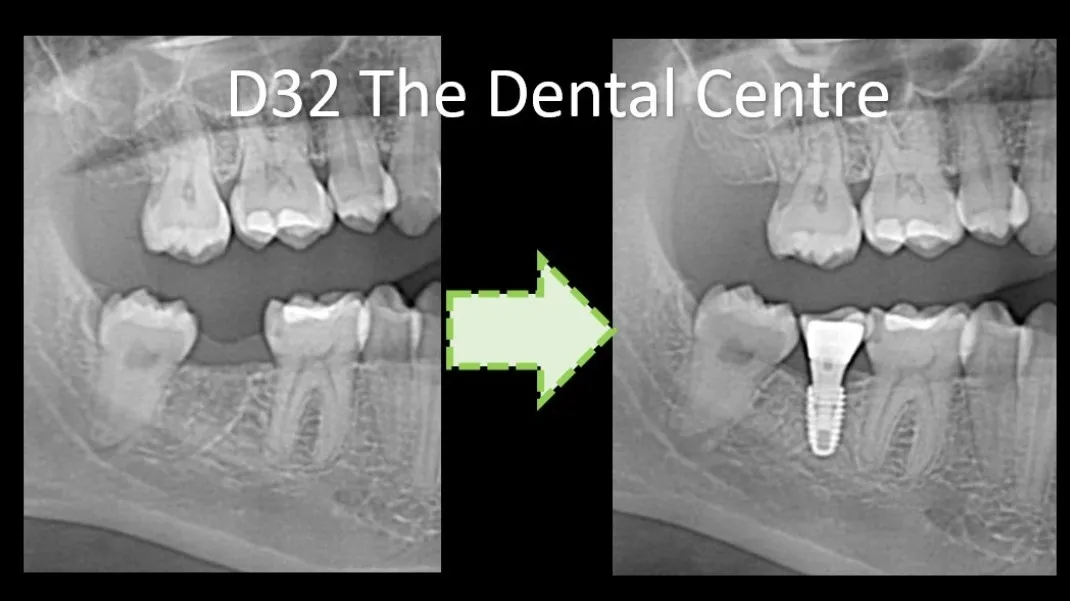 Replace Missing Teeth—Without Compromising Healthy Ones ✨
