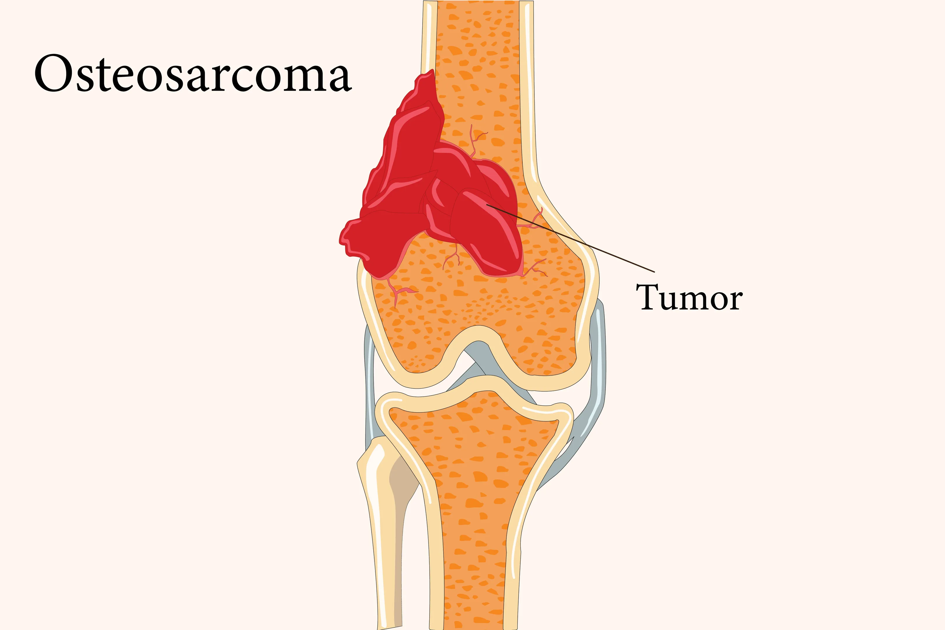 Understanding Osteosarcoma and Its Treatment Options