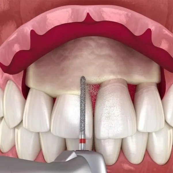 Crown lengthening procedure treatment In vashi