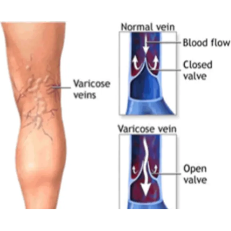 Understanding Laparoscopic Varicose Vein Ligation for Better Leg Health