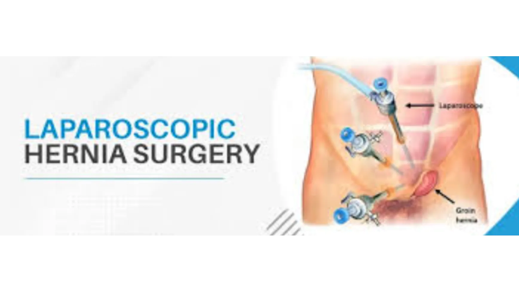Hernia Treatment in Goregaon: Symptoms, Risks and Treatment Options