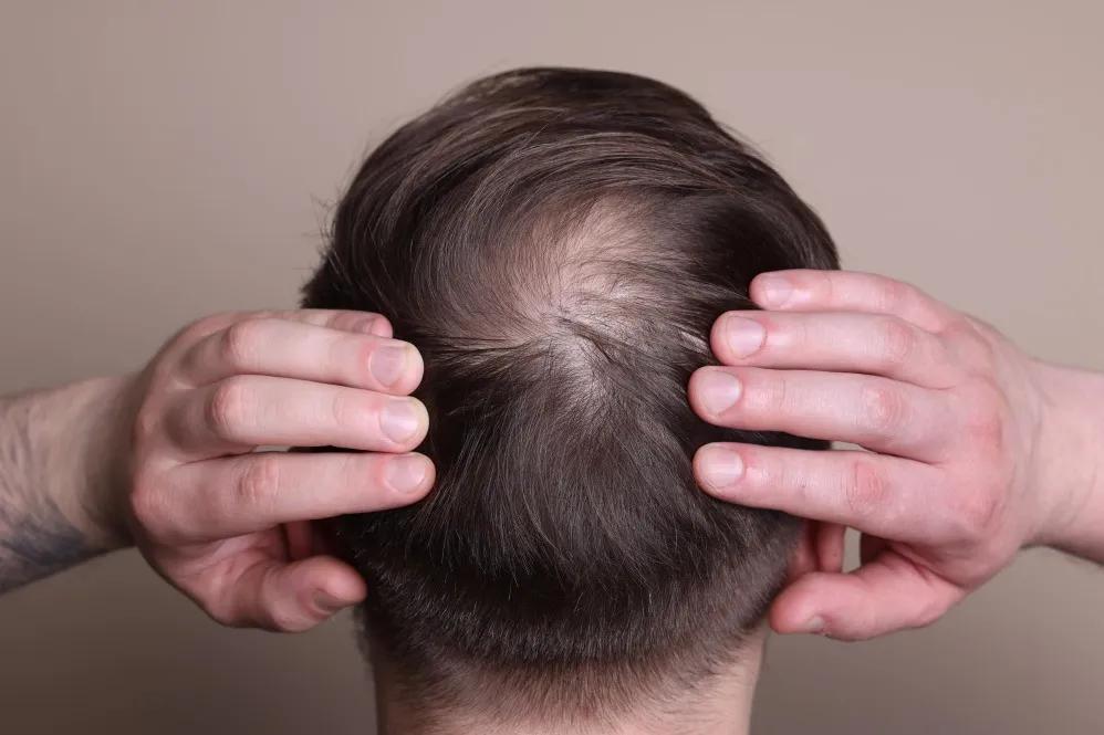 Hair Loss Due to Vitamin Deficiency: How to Identify the Cause Before Starting Treatment