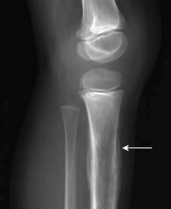 Ewing Sarcoma Explained: Signs, Diagnosis, and Modern Treatment