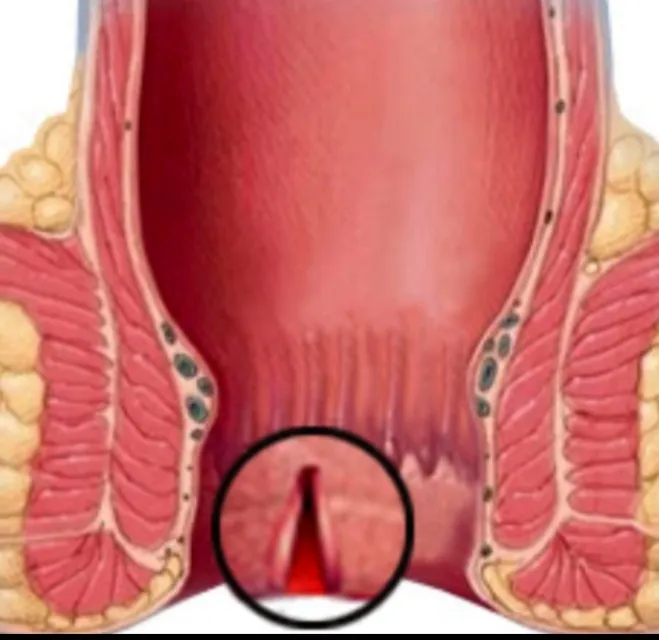 Laser Piles Surgery in Bangalore – A Modern Approach to Faster Recovery