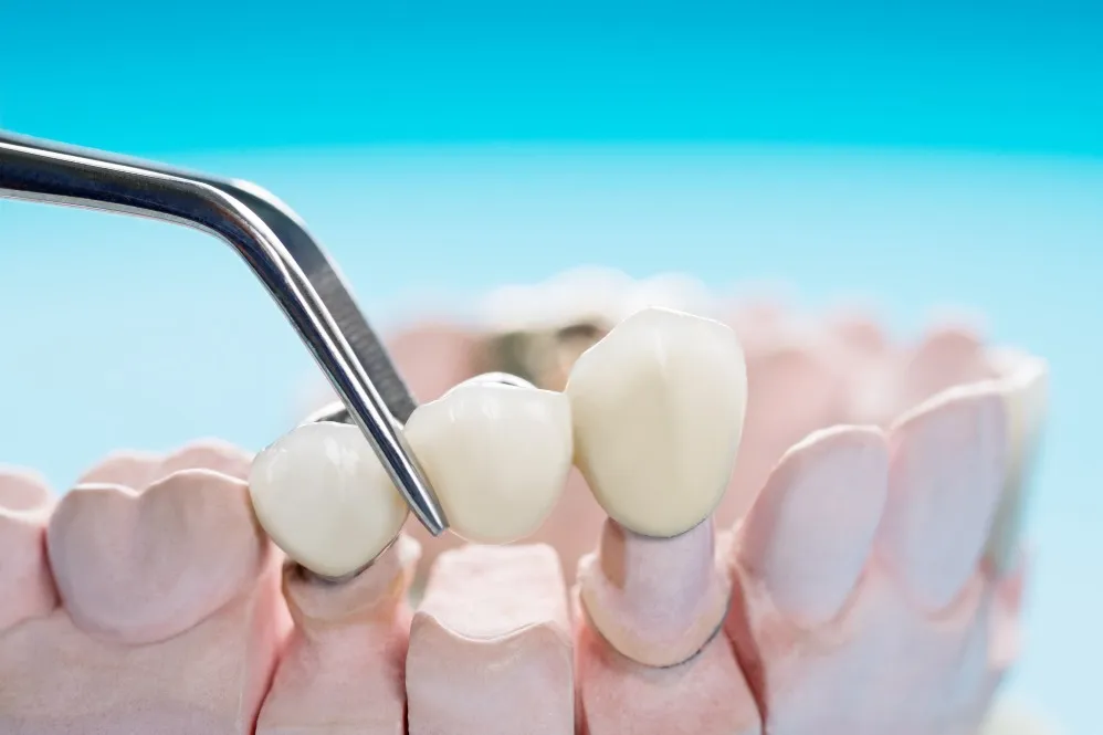 When Do You Need a Crown or Bridge? A Practical Guide to Restoring Damaged Teeth