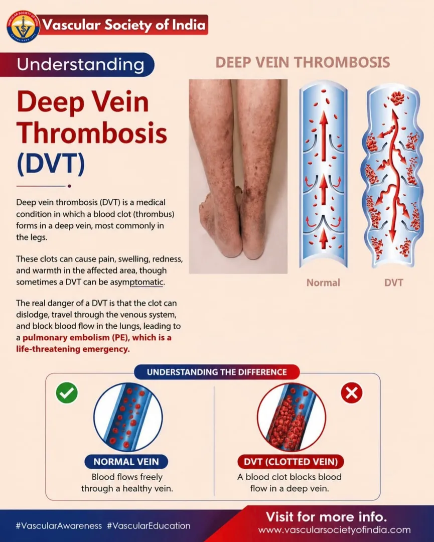 ๐ฉธ Deep Vein Thrombosis (DVT): Know the Signs with Dr. Sharath Rajkumar