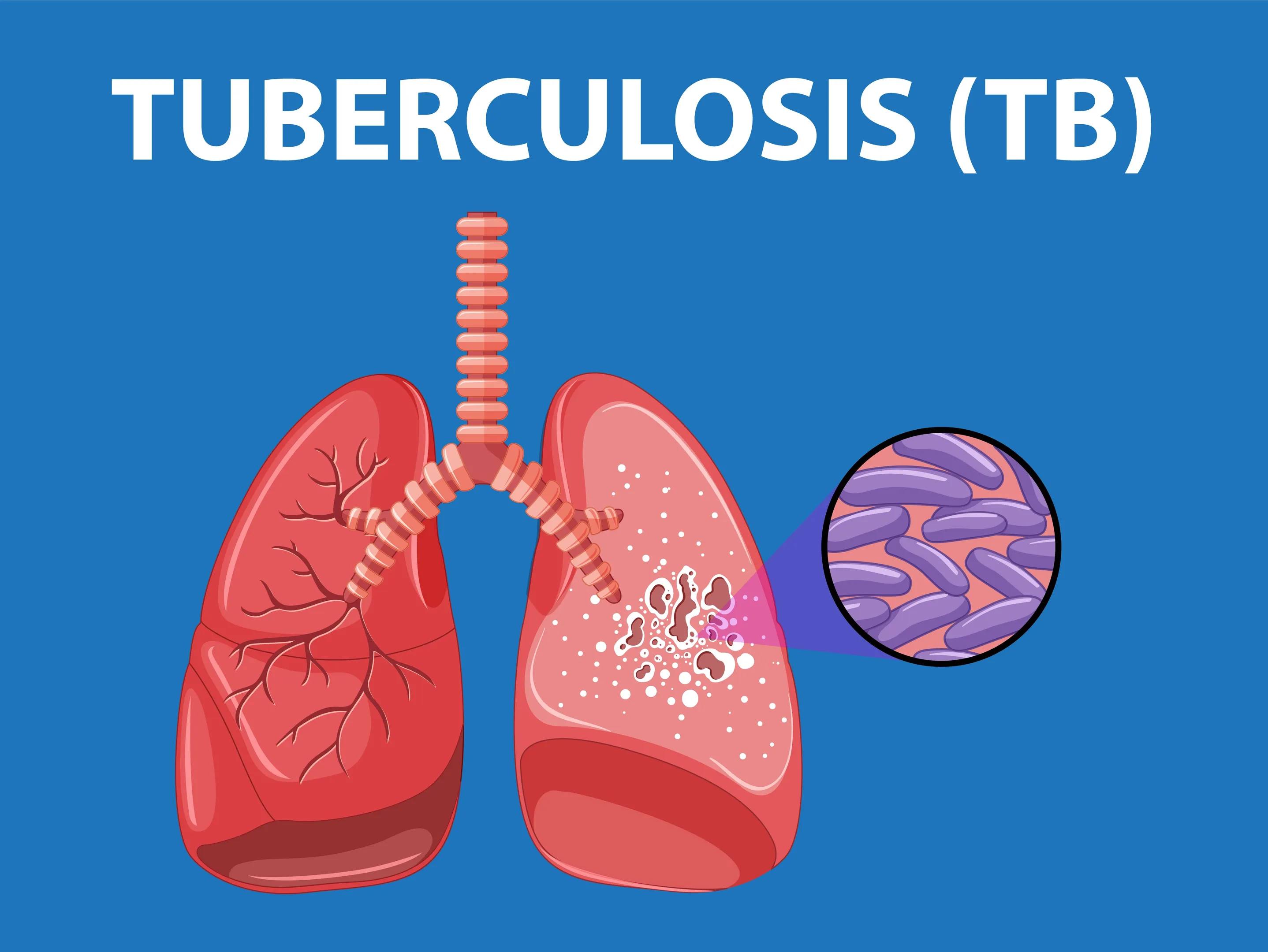 Tuberculosis Specialist in Pune: Early Signs, Diagnosis, and Why Timely Treatment Matters