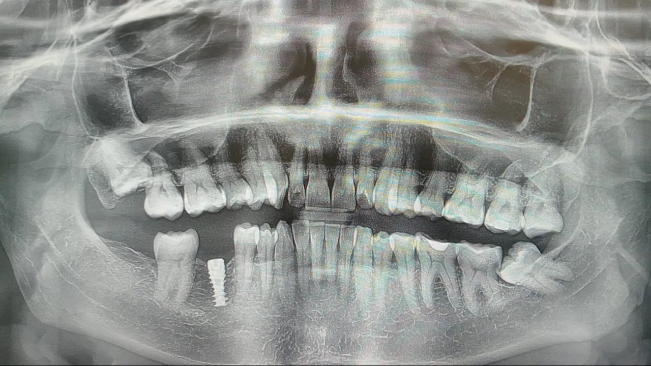 Implant or Bridge β Which is the better long-term solution?