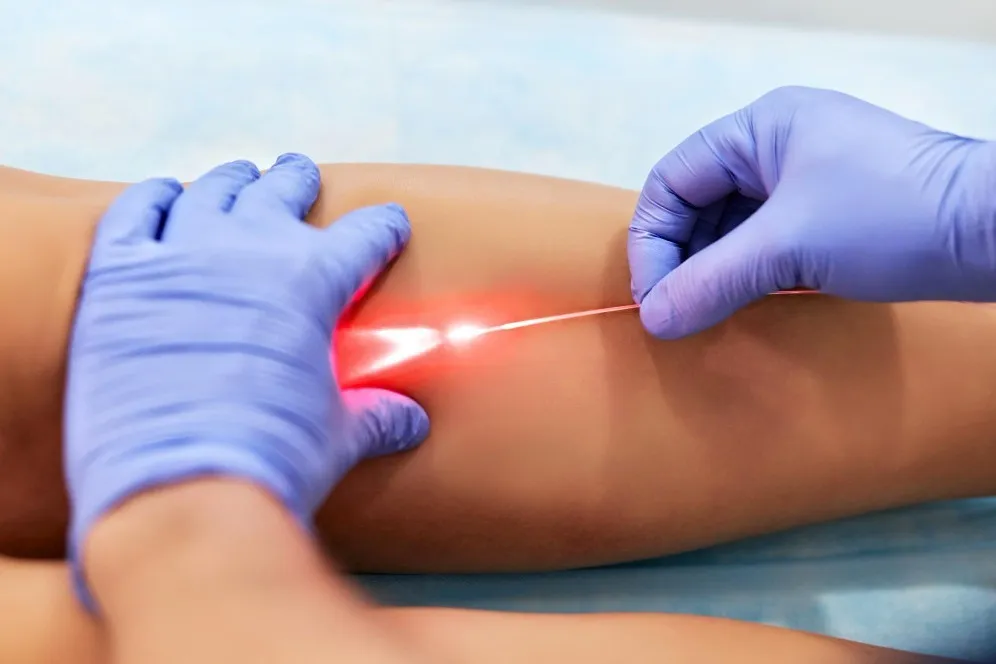 Varicose Veins Laser Surgery in Lalbaug – Addressing Vein Problems Before They Progress