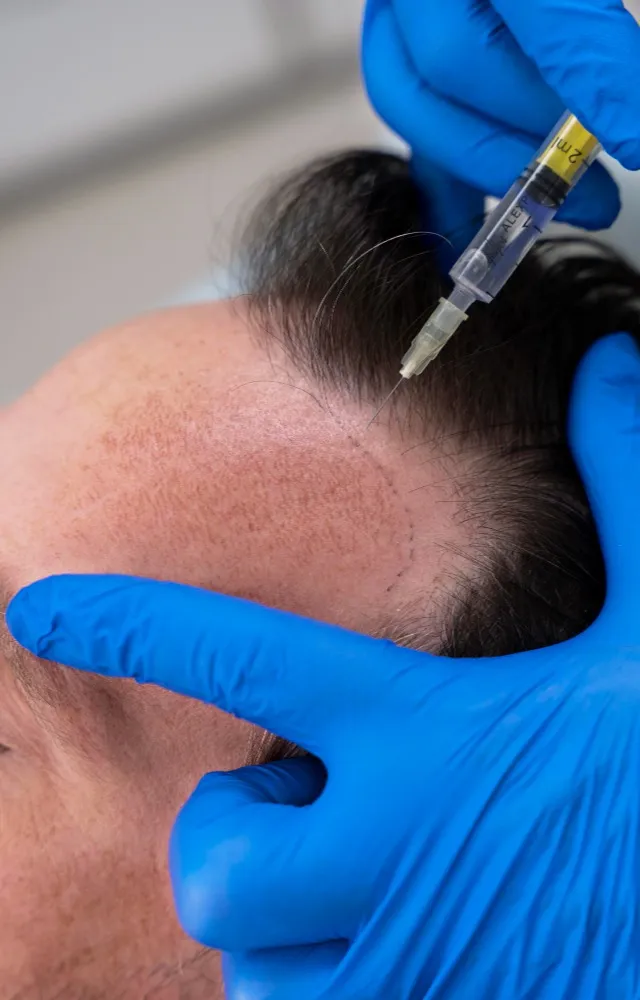 Hair Loss Treatment in Pune – Looking Beyond the Surface of Hair Fall
