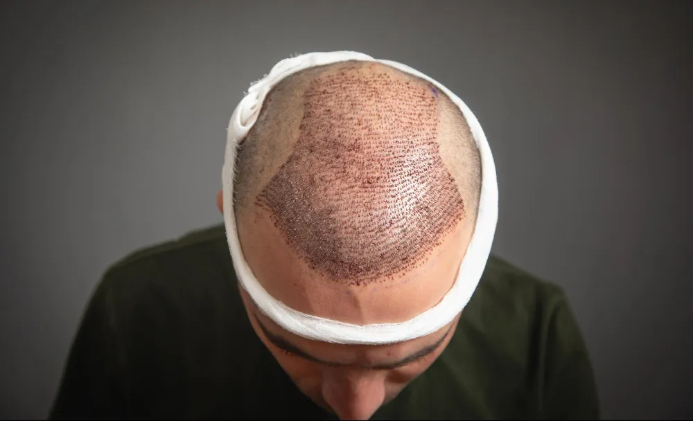 Hair Transplant for Men in Chennai: Who Is the Right Candidate and What Can You Expect?