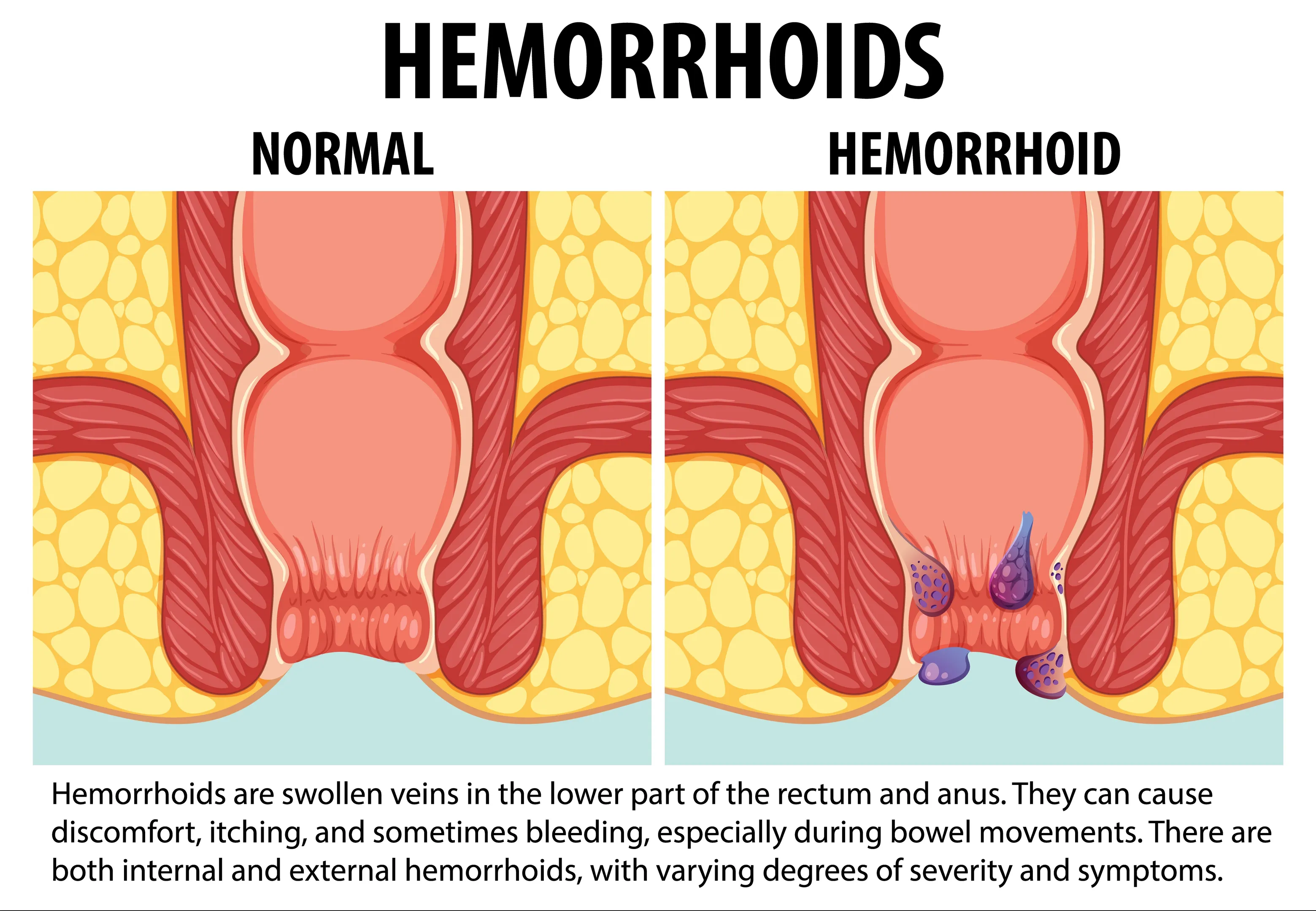 When Is Hemorrhoid Surgery Necessary? A Practical Guide for Patients