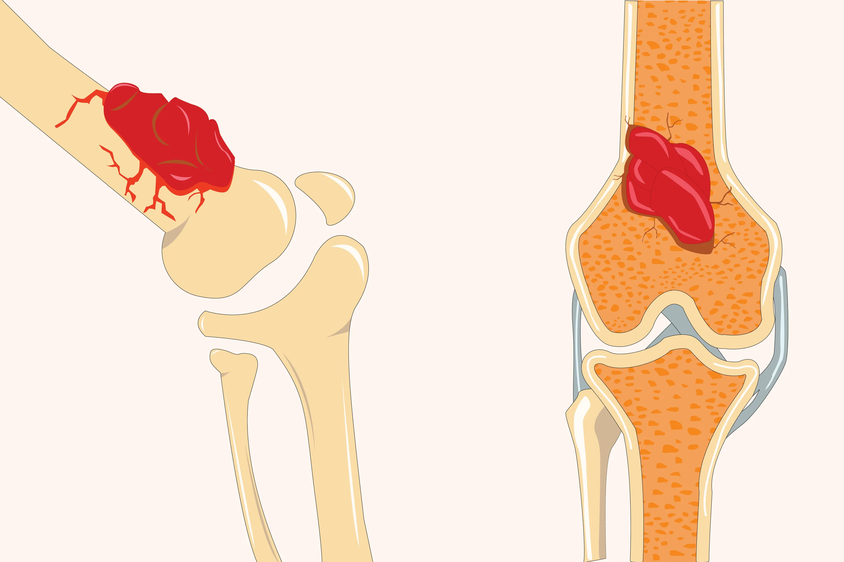Soft Tissue Sarcoma: How to Recognize the Signs Before It Becomes Serious