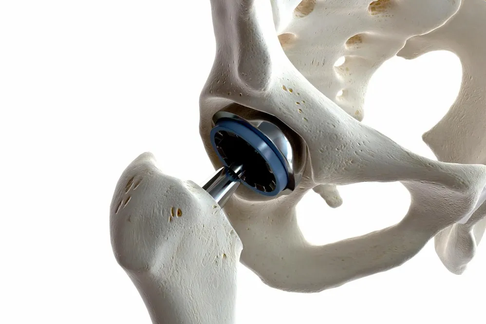 Hip Replacement Surgery: 10 Signs It May Be Time to Consider the Procedure