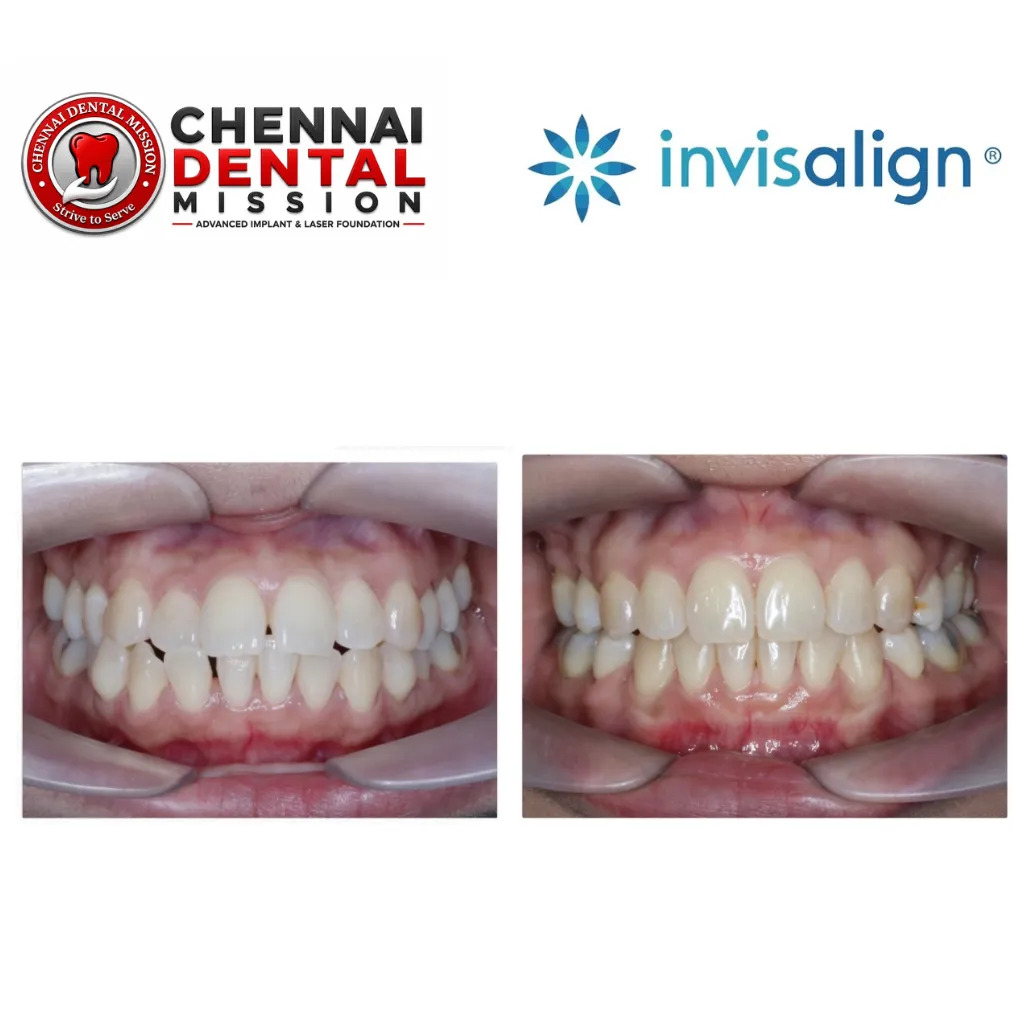 Can Clear Aligners fix just one crooked front tooth?