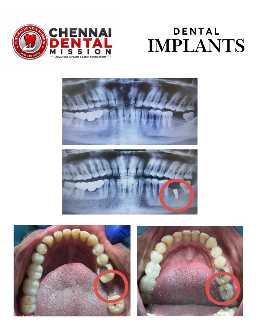 Can I replace a missing front tooth with a dental implant?