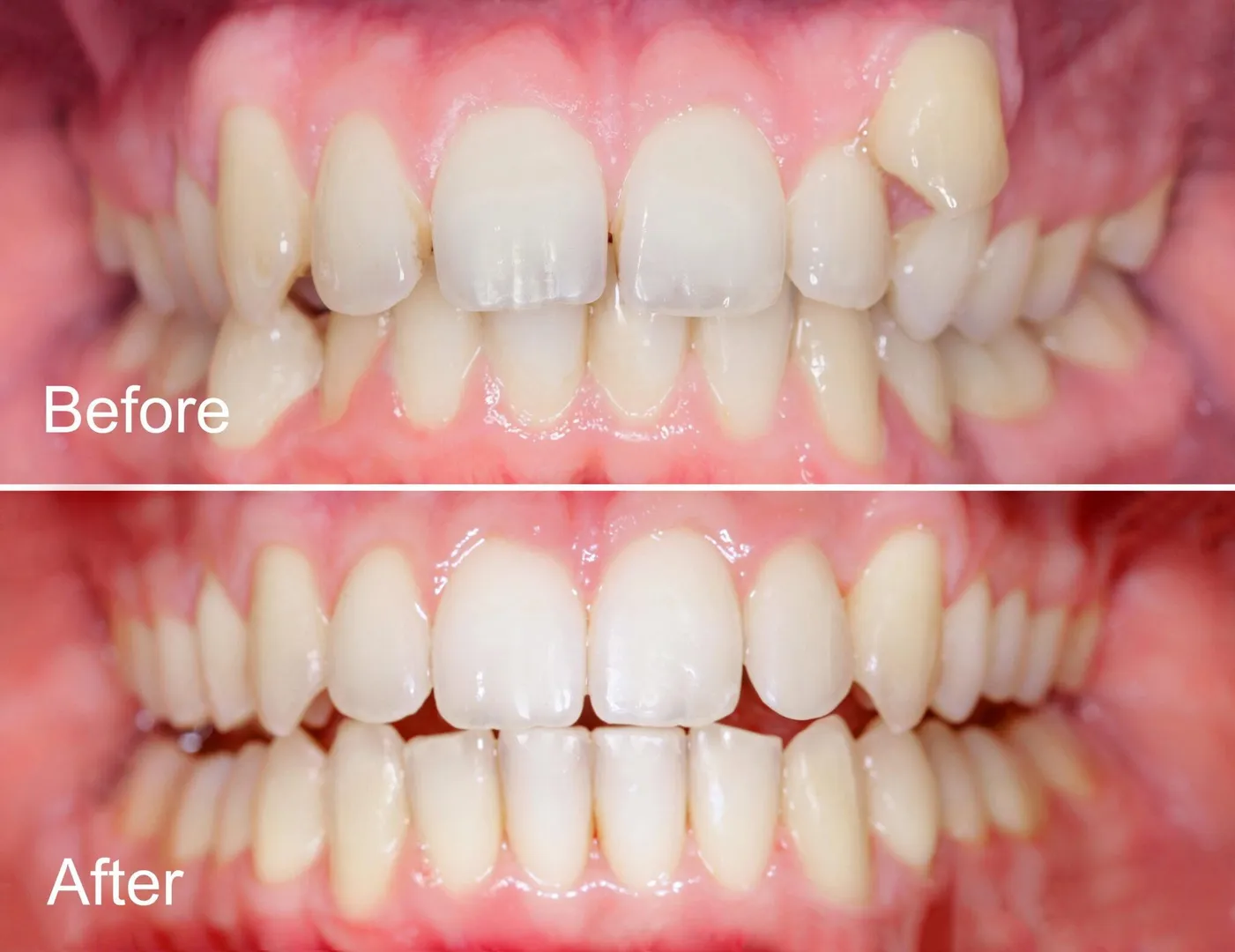 Straighten Teeth Without Braces: Modern Alternatives for a Confident Smile