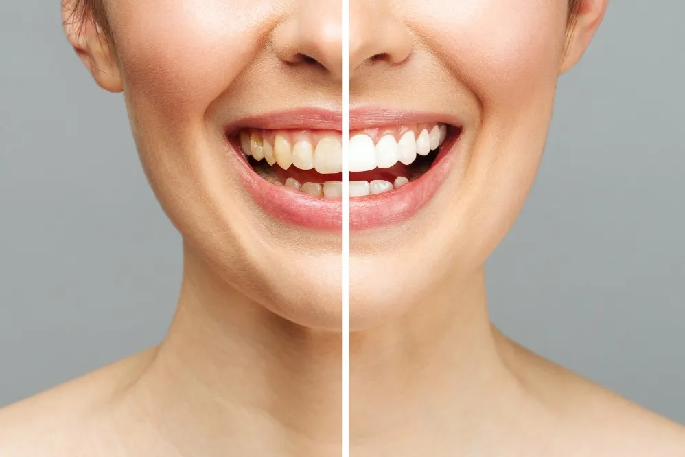 Teeth Whitening in Vikas Puri – Brighten Your Smile with Professional Care