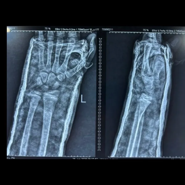 10 YEARS OLD BOY TREATED WITH CLOSED REDUCTION AND PLASTER FOR WRIST FRACTURE
