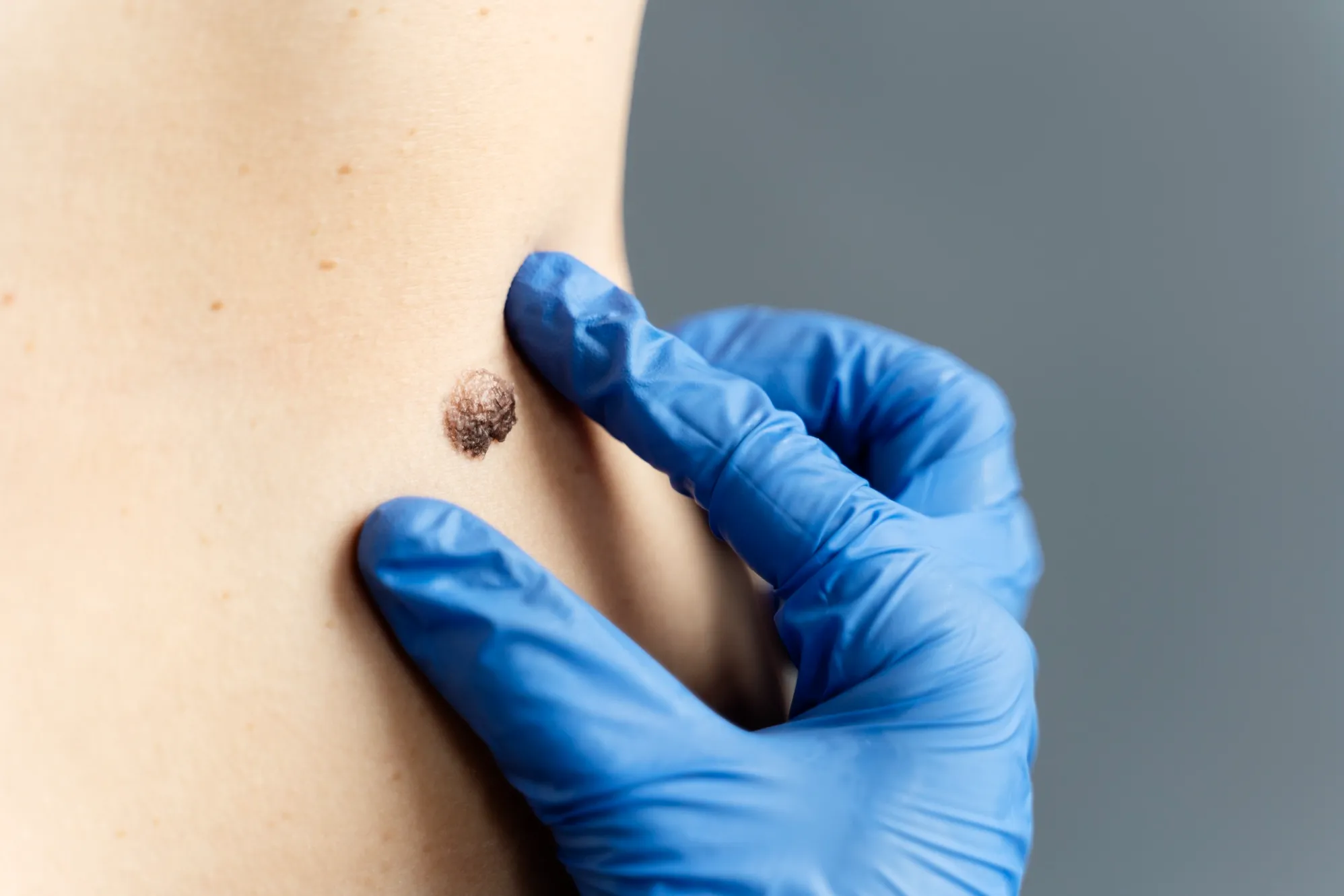 Lipoma Removal Specialist in Parel – Understanding Benign Soft Tissue Lumps
