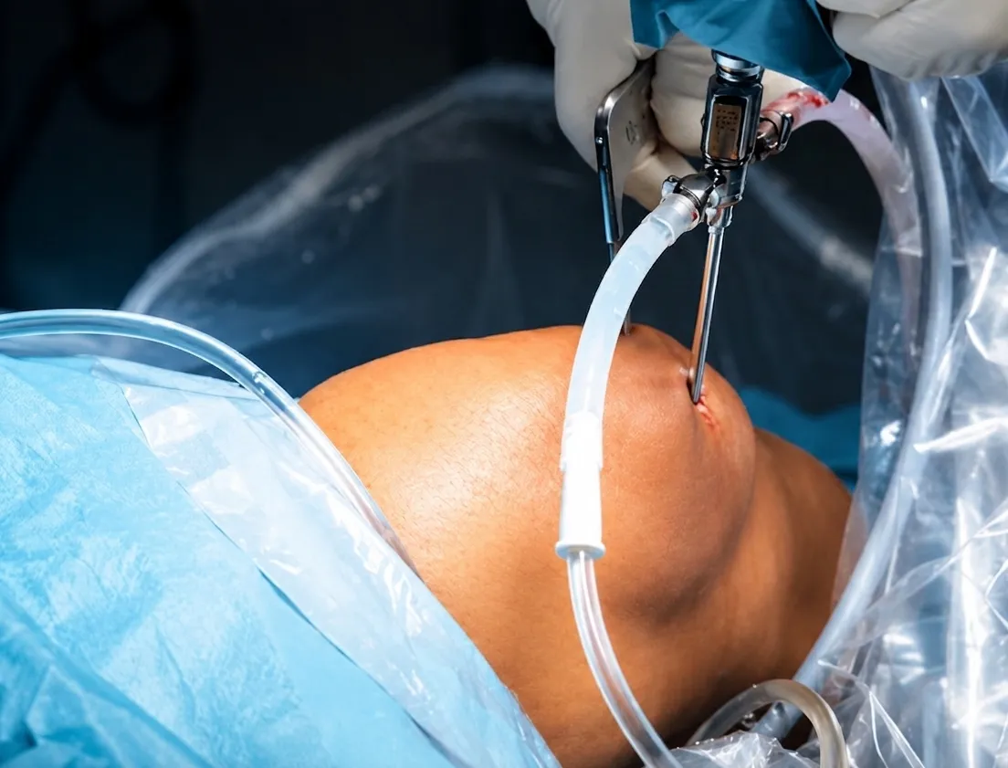 Limb Salvage Surgery vs Amputation: Which Is the Better Option for Bone Cancer?