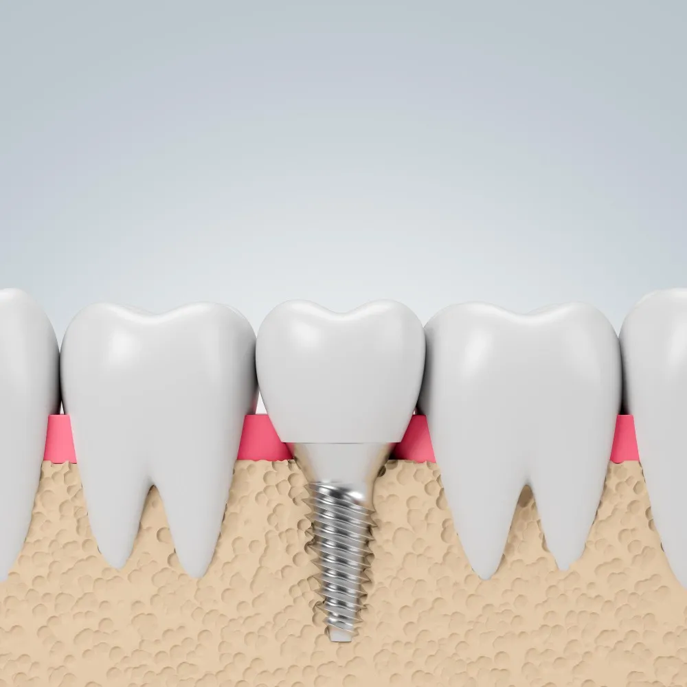 Digital Dental Implants: How Technology Supports Precise Planning