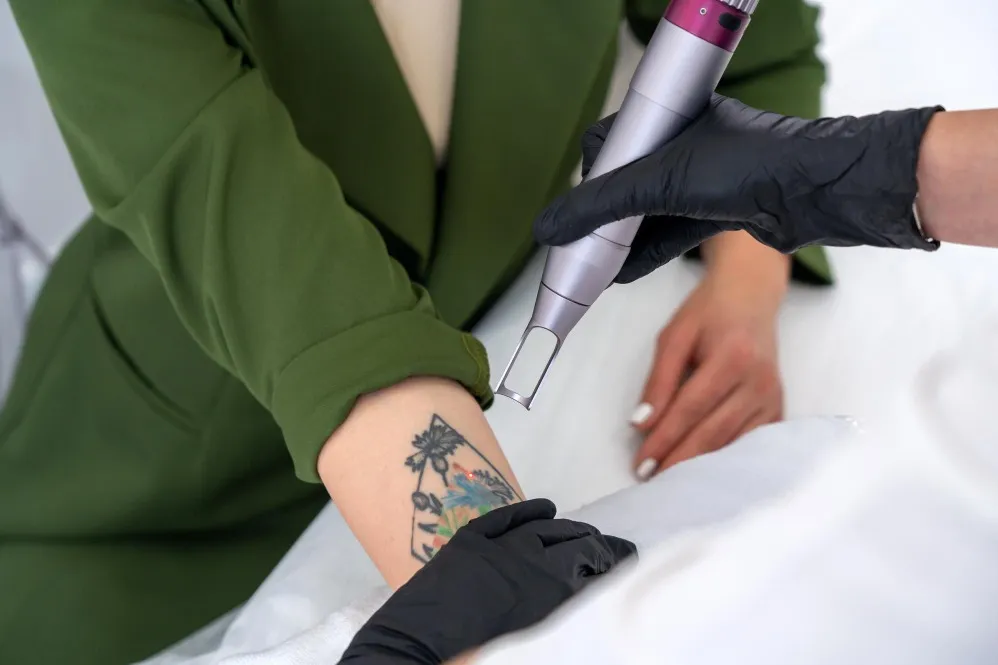 Laser Tattoo Removal Treatment in Malleshwaram