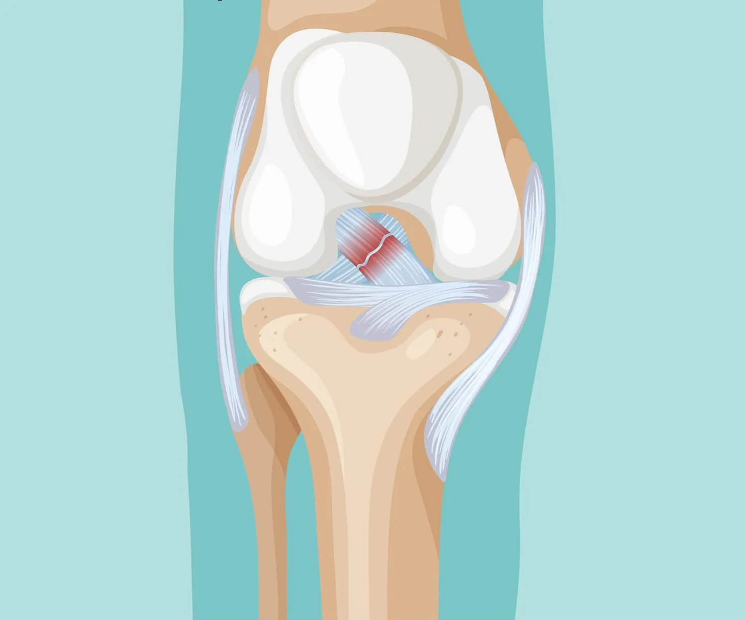 ACL Reconstruction Surgery: Who Needs It and What to Expect During Recovery