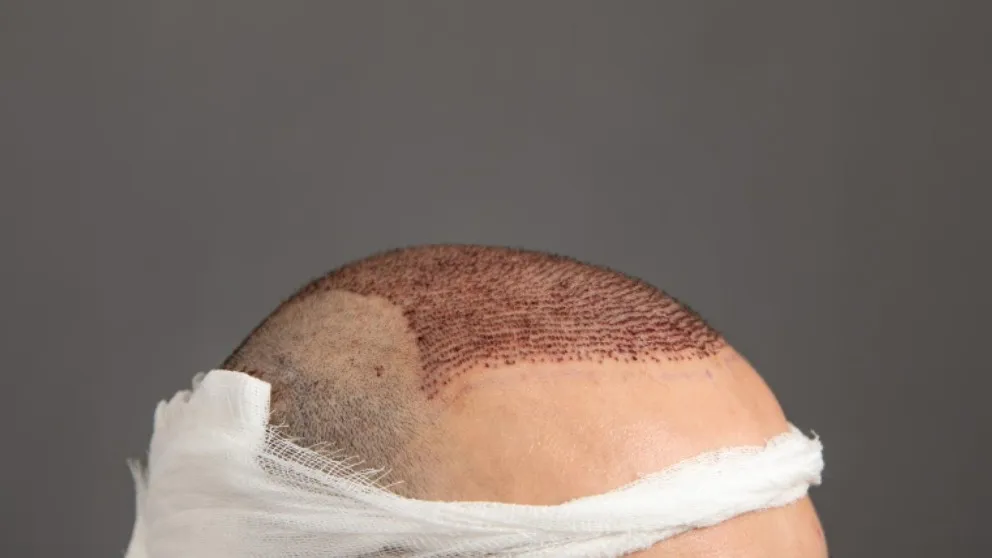 Hair Transplant Cost in Mumbai: What Determines the Final Price?
