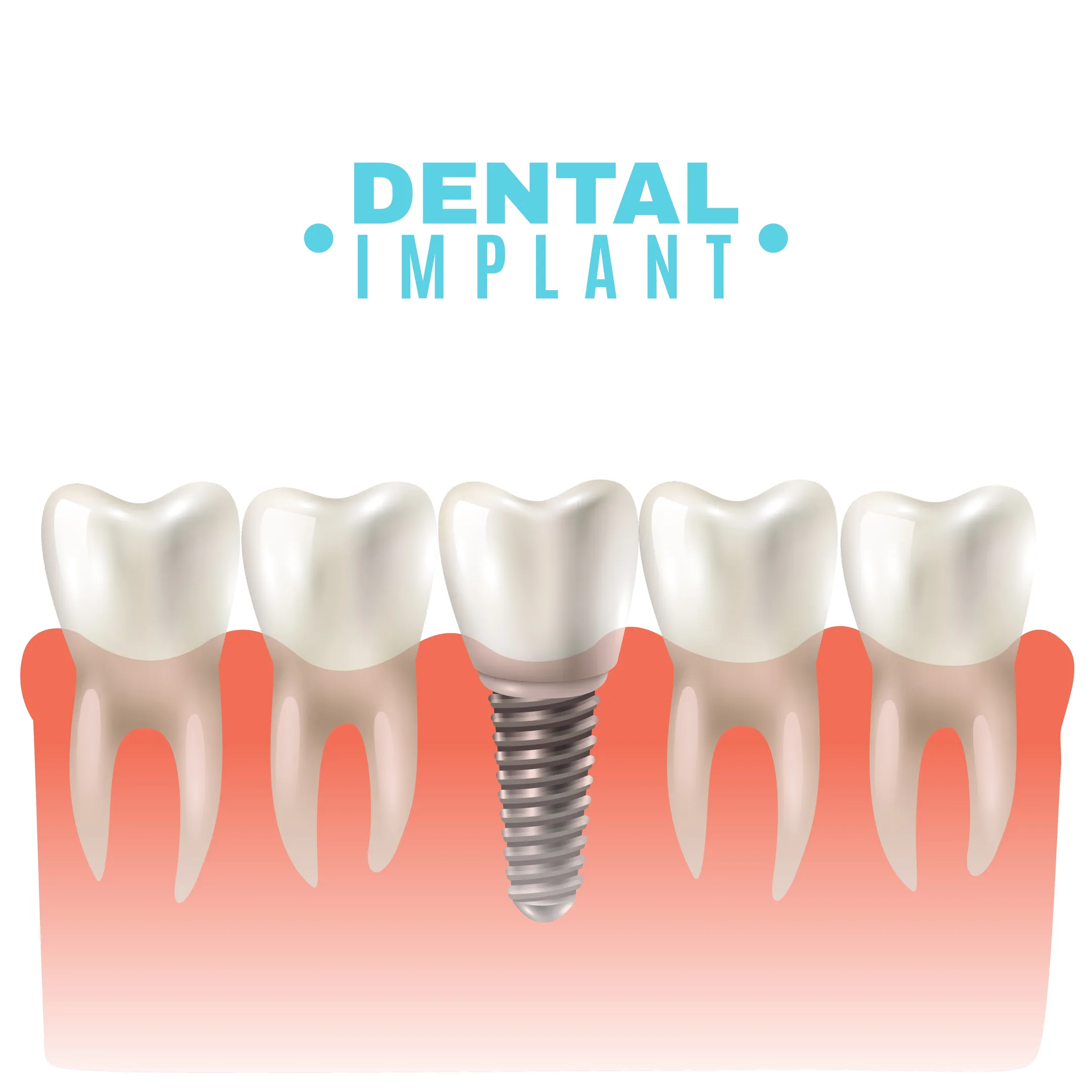 Dental Implants in HBR Layout for a Stronger and Natural-Looking Smile