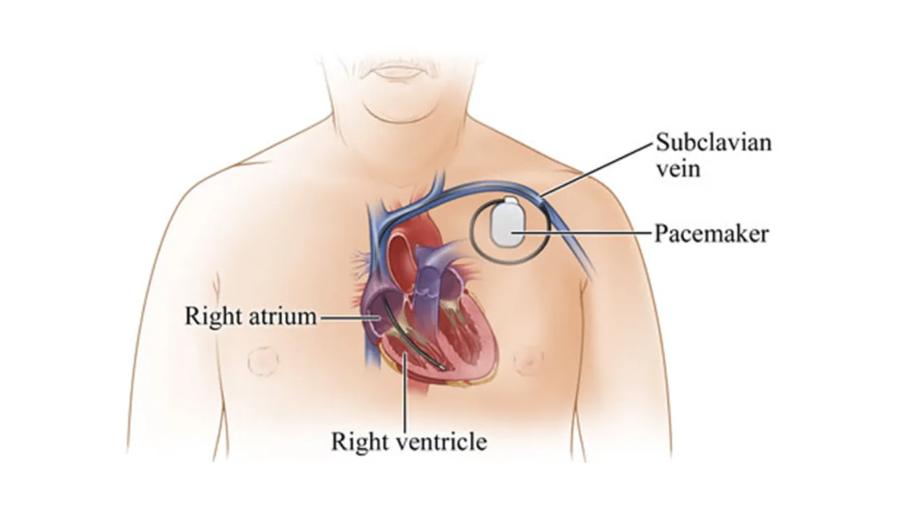 Temporary Pacemaker in Kalyan: When Emergency Heart Rhythm Support Is Needed