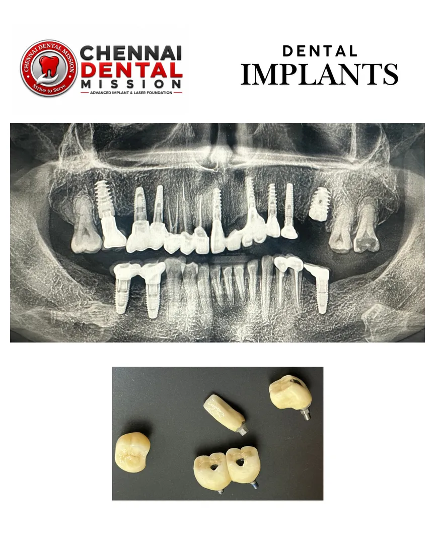 Can a loose denture be replaced with fixed teeth?