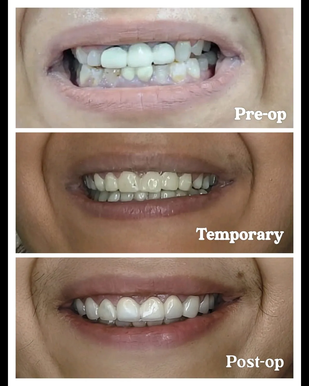 How Long Do Veneers Last? Lifespan, Care & When to Replace Them